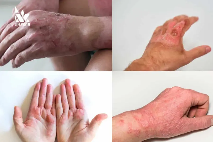 bỏng da do xút